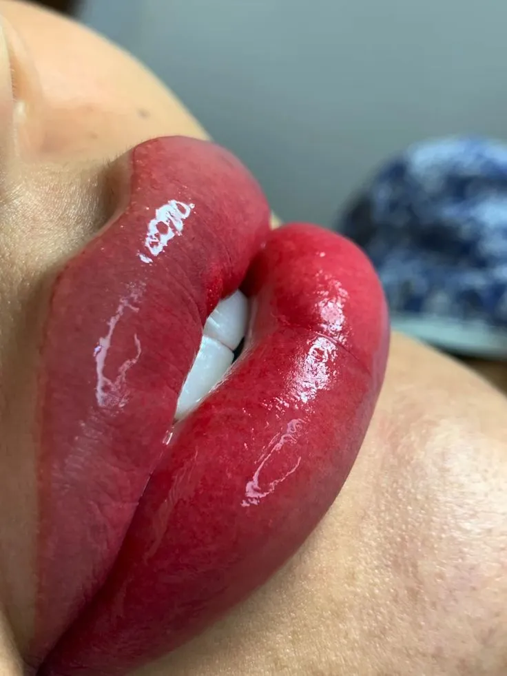 Aumento de labios